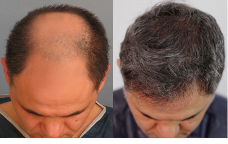 Main Reasons To Prefer Hair Restoration Process Over Alternatives!
