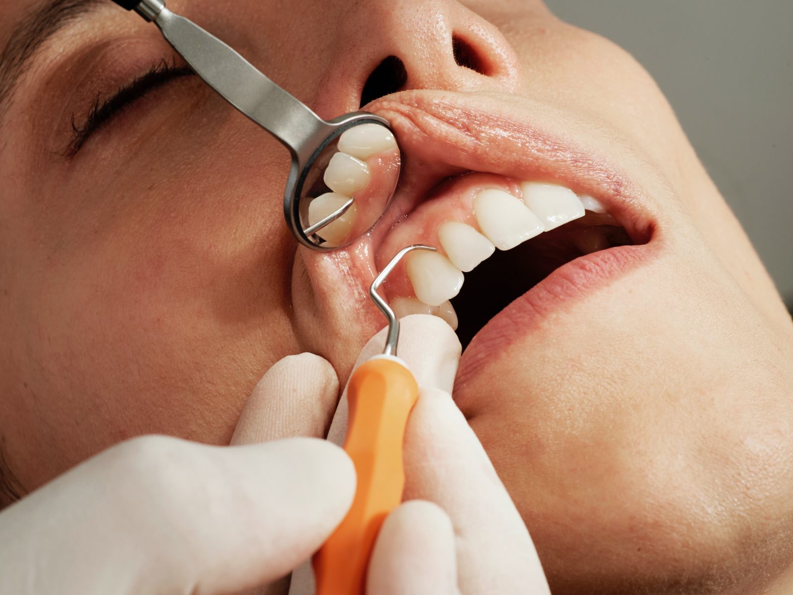 Everything You Need to Know about Gum Disease