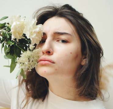 5 Common Causes For Face Acne That Everyone Should Know, From Pillow To Nutrition