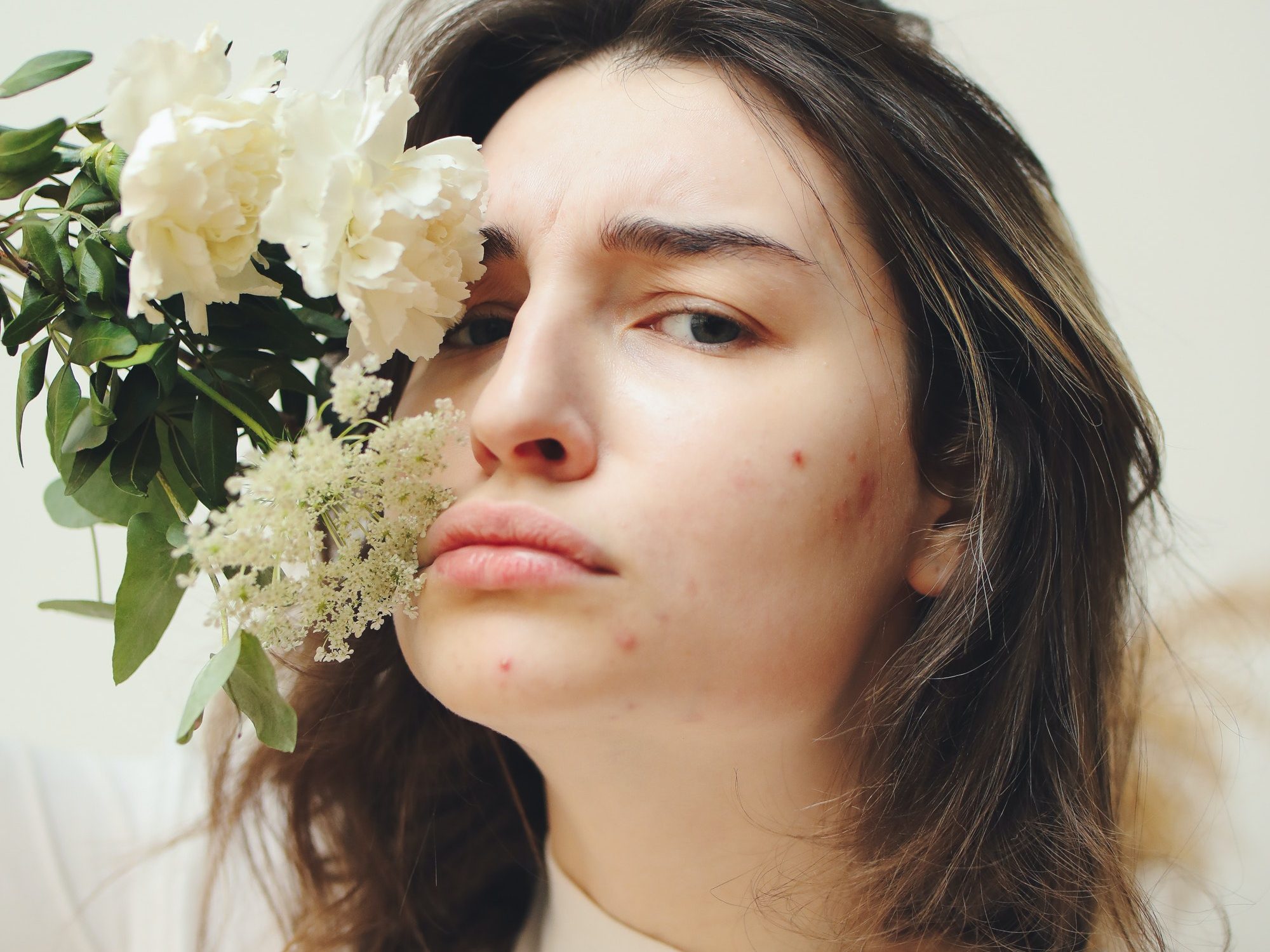 5 Common Causes For Face Acne That Everyone Should Know, From Pillow To Nutrition