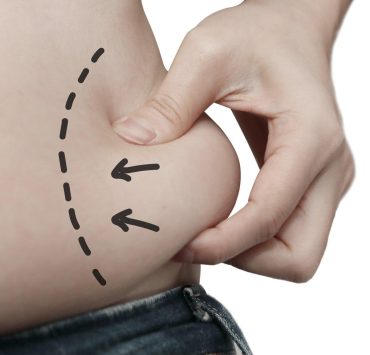 Tummy Tuck Gone Wrong: 3 Common Tummy Tuck Complications